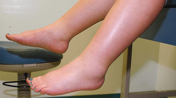 Отеки и задержка жидкости в организме: Избавление от отеков и достижение гармоничного веса