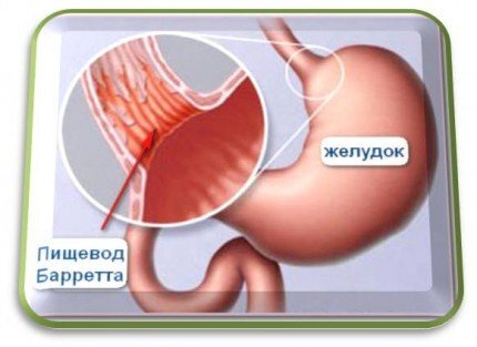 Ахалазия кардии