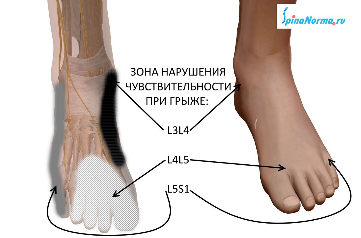 Остеохондрозис голеностопного сустава