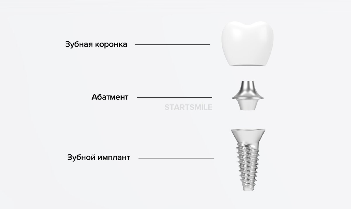 Лучшие импланты 2.0