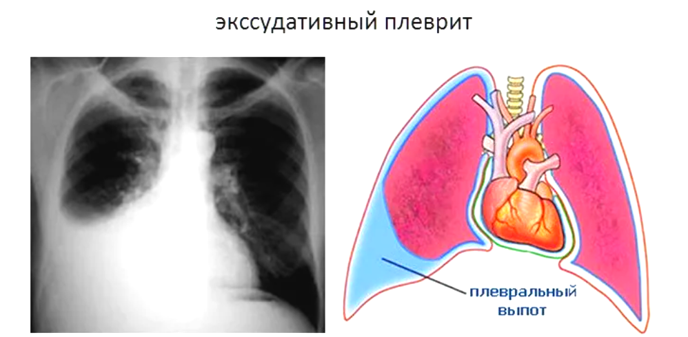 Рисунок 2-Экссудативный плеврит: отставание грудной клетки в акте дыхания