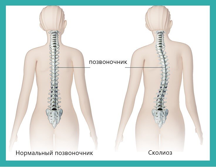 13 упражнений из йоги для исправления сколиоза