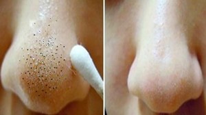 Нерегулярная гигиена.