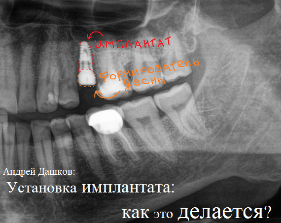  
Добрый день уважаемые друзья! Сегодня мне бы хотелось рассказать, а главное, показать вам — как проходит операция по установке имплантата — со всеми инструментами и прочим. Если про процесс удаления зуба, в частности зуба мудрости — я уже рассказывал, то настало время поговорить о чем-то более серьезном.
