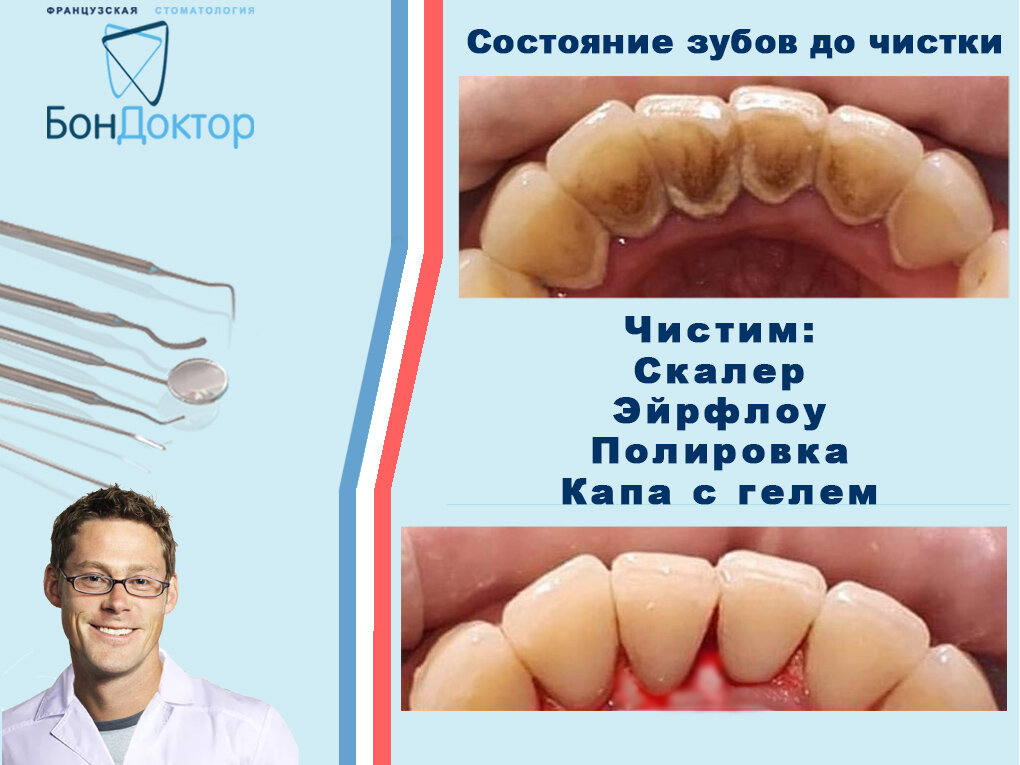 Профессиональная чистка зубов. Памятка после отбеливания зубов для пациентов. Сколько нельзя пить после чистки. Неправильная чистка зубов. Памятка белая диета после отбеливания.