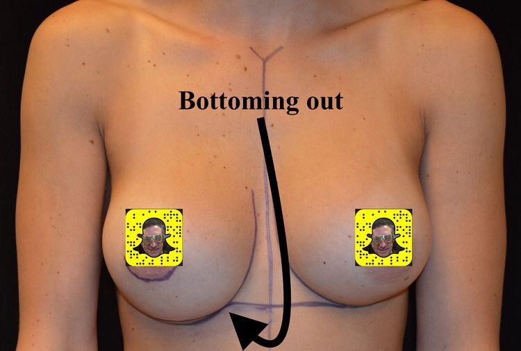 Смещение импланта при Bottoming out 