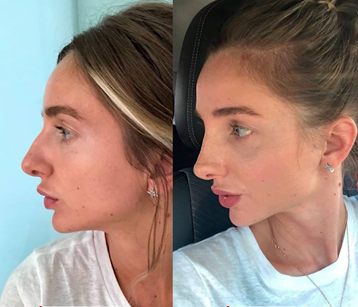 Ринопаластика - пластическая операция по изменению формы носа. 