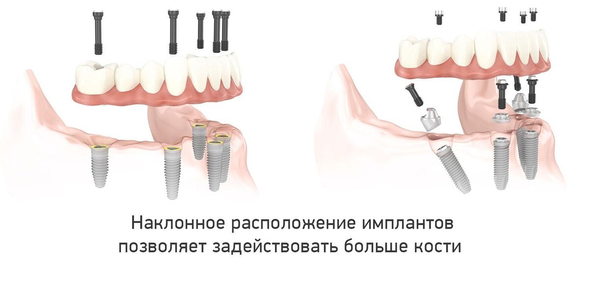 Но установка имплантов все-таки атравматична, то есть полностью безопасна. Фото: Smile-at-Once.ru 