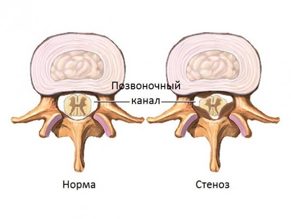 Сужение позвоночного канала