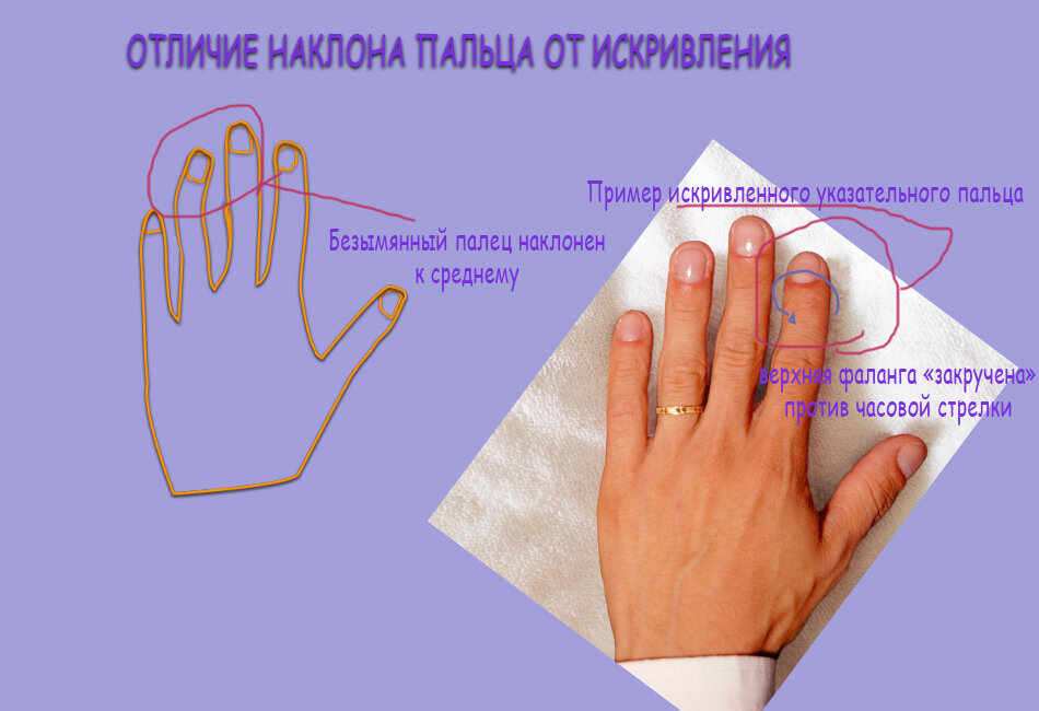 Что вызывает онемение пальцев рук - МУ 