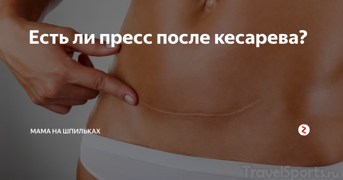 После кесарева сечения через сколько уходит живот. Живот после кесарево сечения. Пресс после кесарева сечения. Пресс с кесаревым сечением