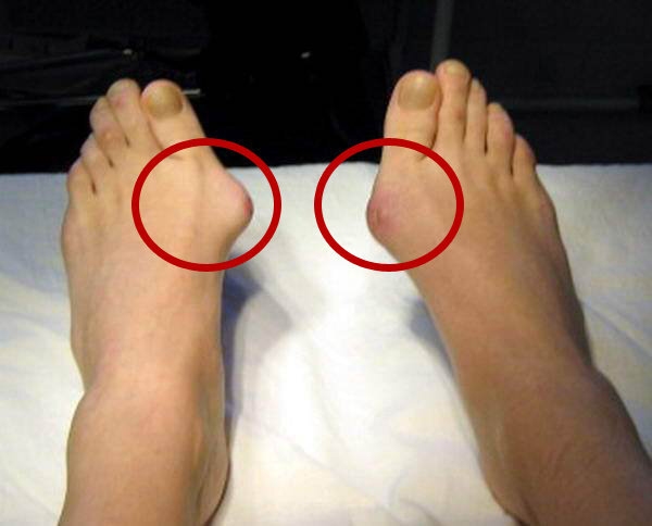 косточка на большом пальце, лечение косточки на пальце, здоровье, медицина, шишка на пальце ноги