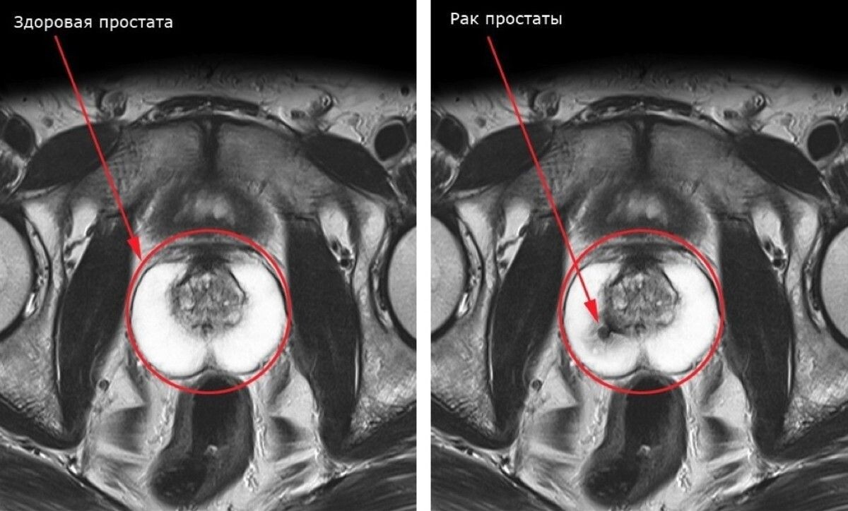 
Рак простаты, к которому всегда приводит простатит – вопрос лишь времени