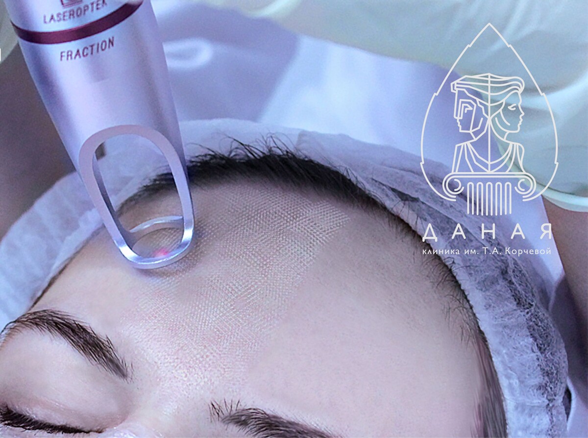 Процедура лазерного фракционного фототермолиза