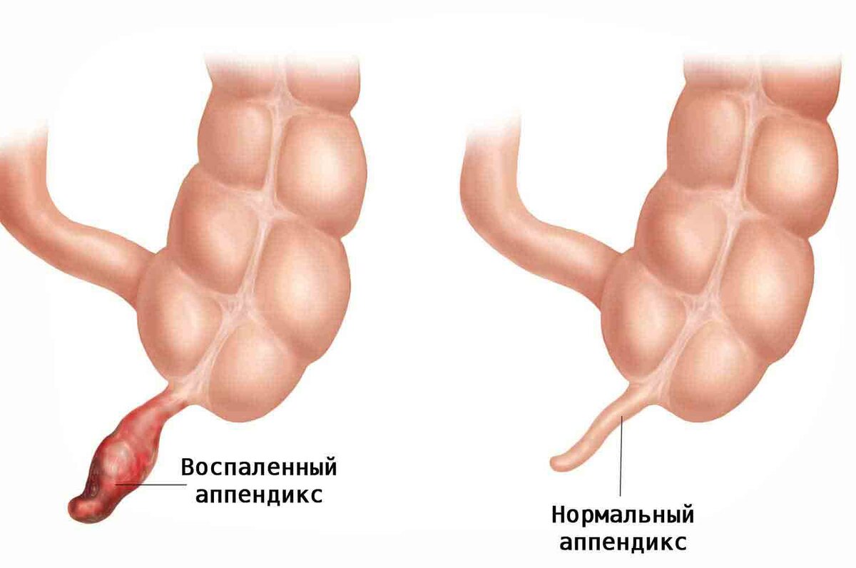 Аппендицит симптомы у женщин фото