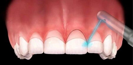Лазерная гингивэктомия – удаление небольшого участка десны над коронкой зуба