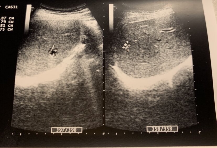 Слева на Узи- киста печени, справа- признаки гемангиомы