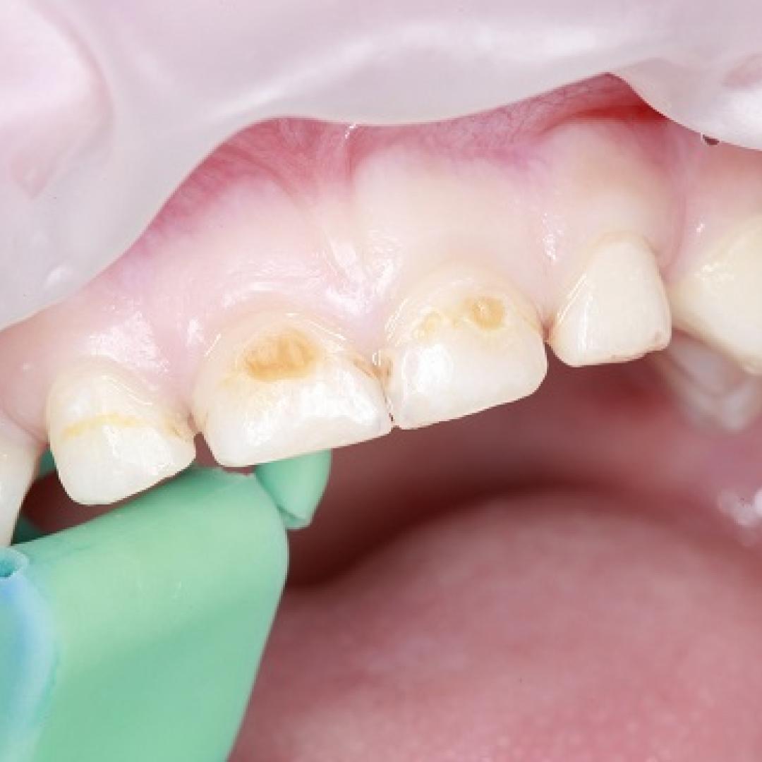 Черные зубы и налет Пристли у детей: как убрать и вылечить