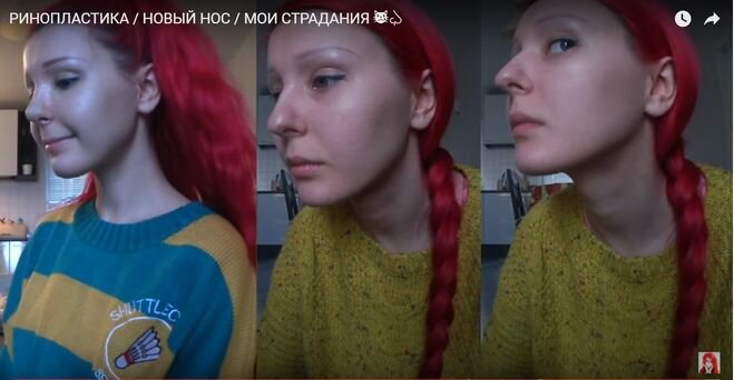 Аня до и после операции Пластические операции.Быть или не быть. Рубрика Дзен