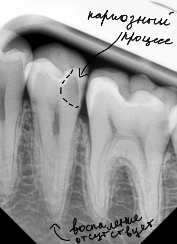 Кариес на снимке. Ортопантомограмма кариес.