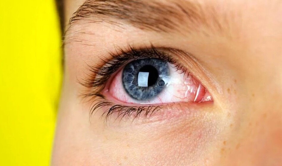 Коронавирус вряд ли передается через слезы, но слизистая оболочка глаза - это ворота для проникновения вируса. Поэтому нельзя дотрагиваться, чесать или иным образом прикасаться к глазам