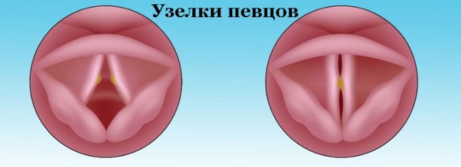 На картинке слева мы видим небольшие новообразования на голосовых складках. Картинка справа демонстрирует затруднение полного закрытия голосовой щели.