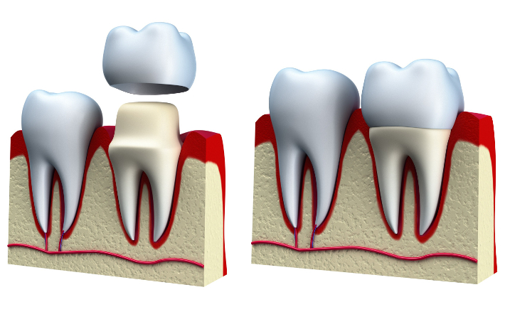 🔎 Коротко Протезирование — это любая процедура по восстановлению утраченных или сильно разрушенных зубов. Искусственную конструкцию, которая заменяет собой зуб или его часть, называют протезом.-3