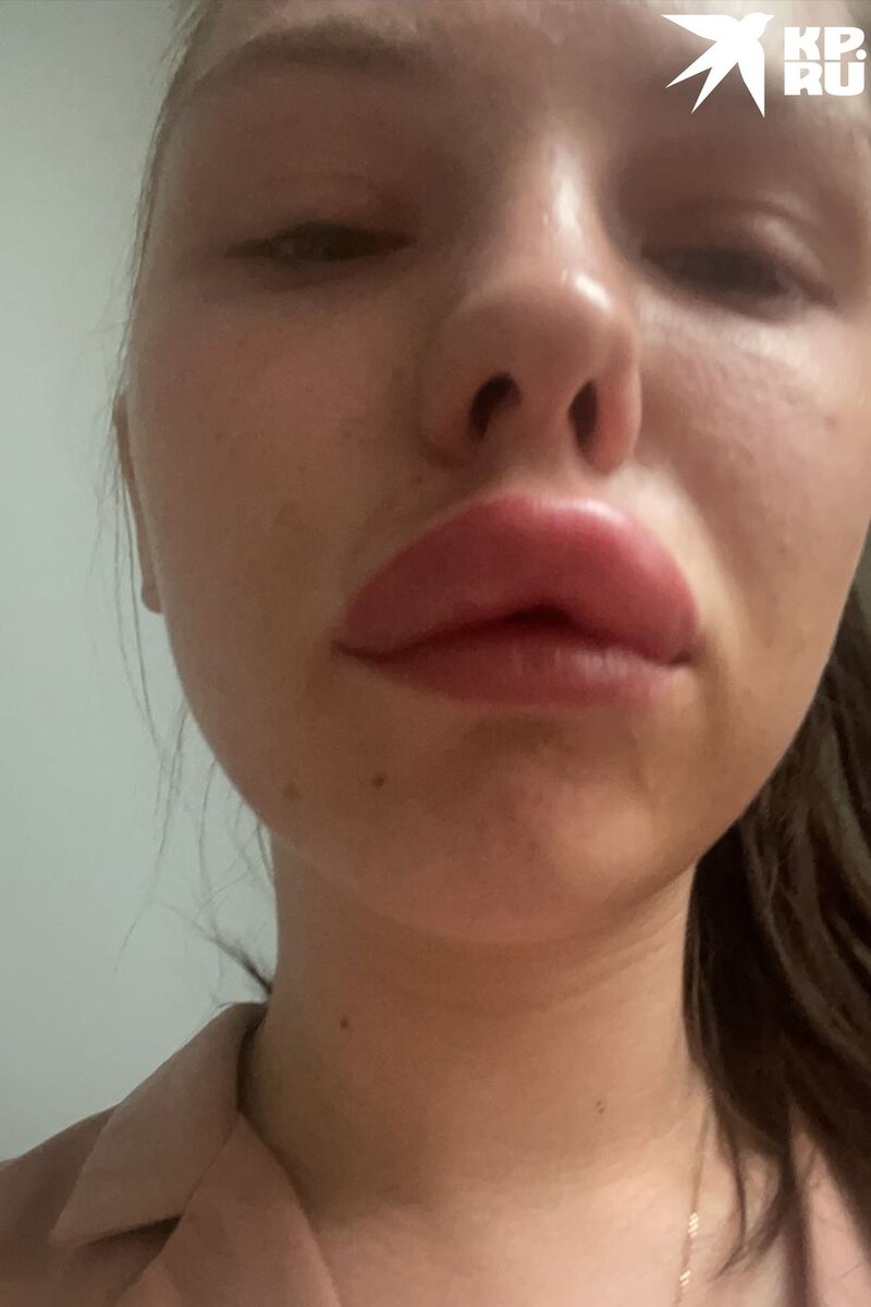    После процедуры появилась аллергия Фото: предоставлено Еленой