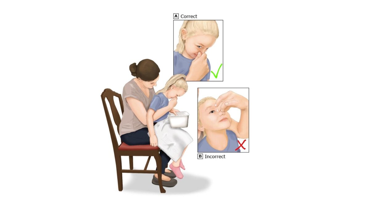 Как остановить носовое кровотечение у ребенка