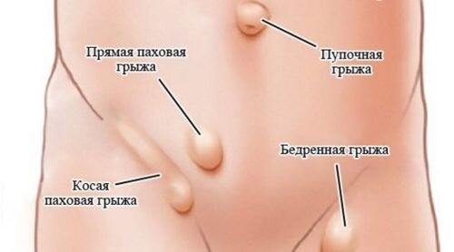 Тазобедренная грыжа. Паховые и бедренные грыжи. Бедренная грыжа у женщин