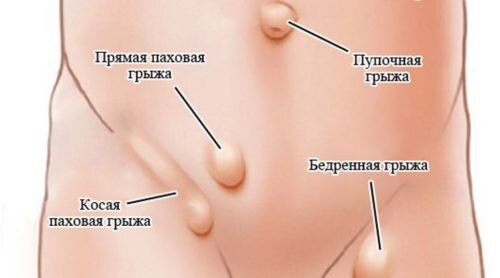 Паховая грыжа у детей презентация