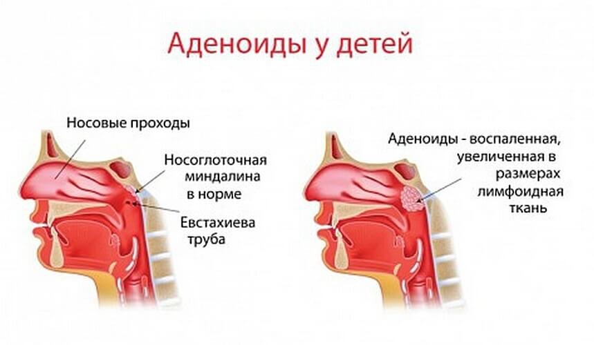 Симптомы аденоидов у детей. Анатомия носоглотки аденоиды. Глоточная миндалина аденоиды. Какилечить аденоиды у детей. Аденоиды симптоматика у детей.