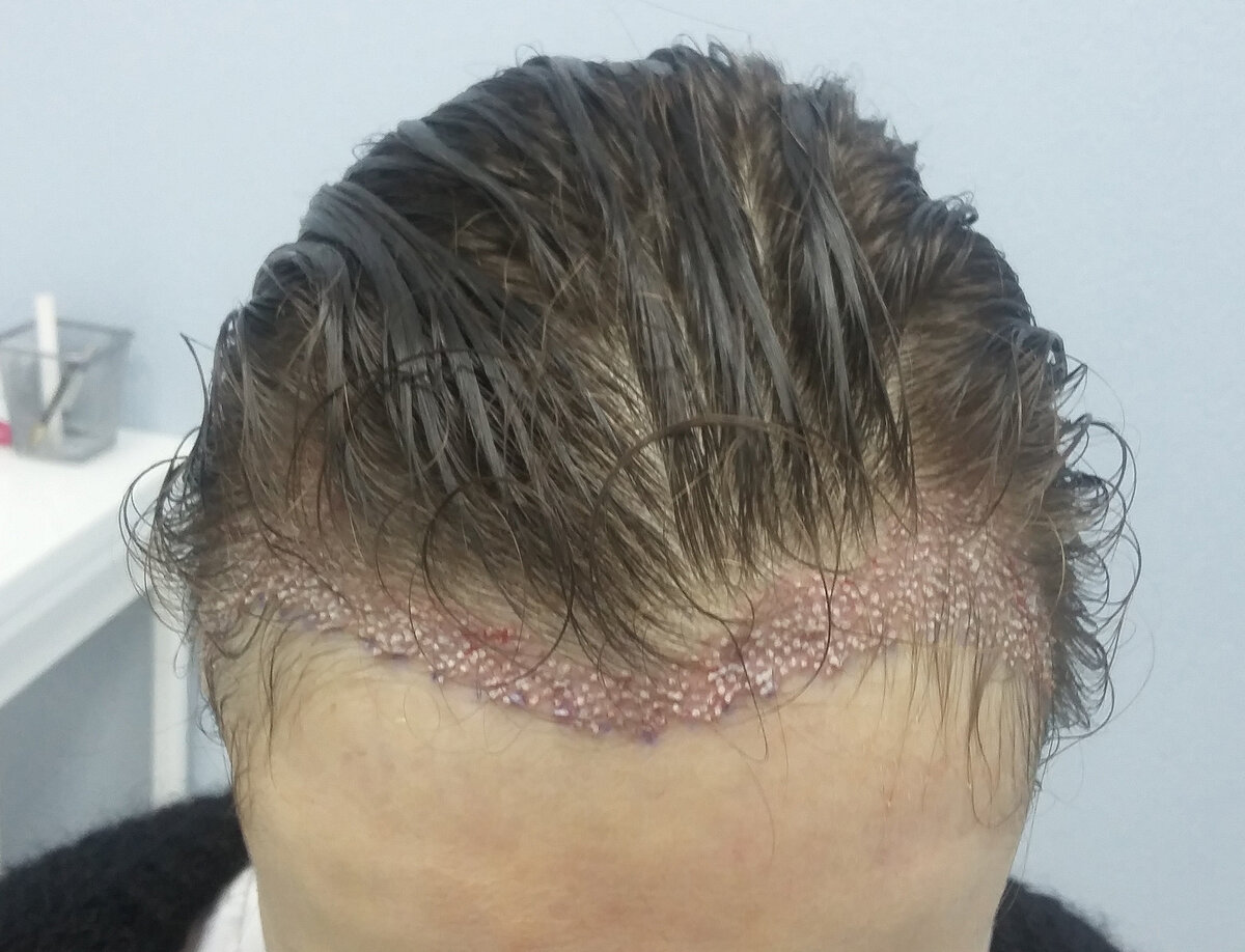 Пересадка волос у женщин (первая линия роста)