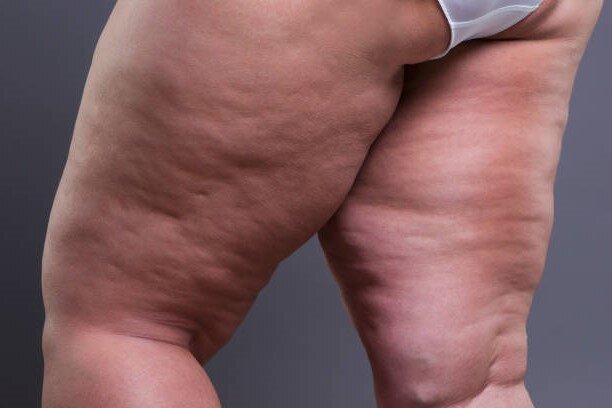 Липедема - что это за болезнь?