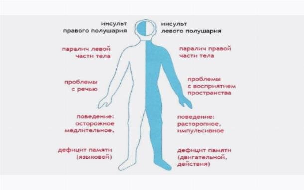 Развитие событий при ишемическом инсульте