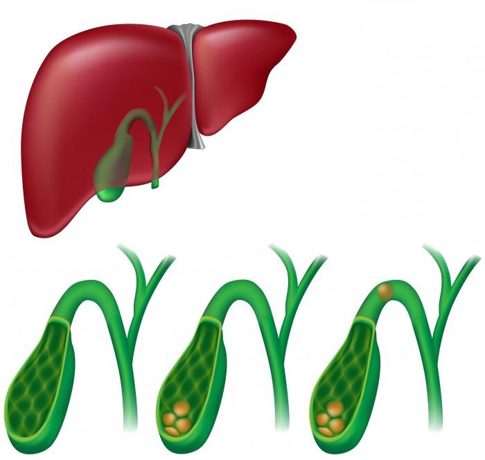 Схематично видно, как камни с дна желчного могут перекрыть отток для желчи в его шейке от чего при сокращении возникает болевой приступ