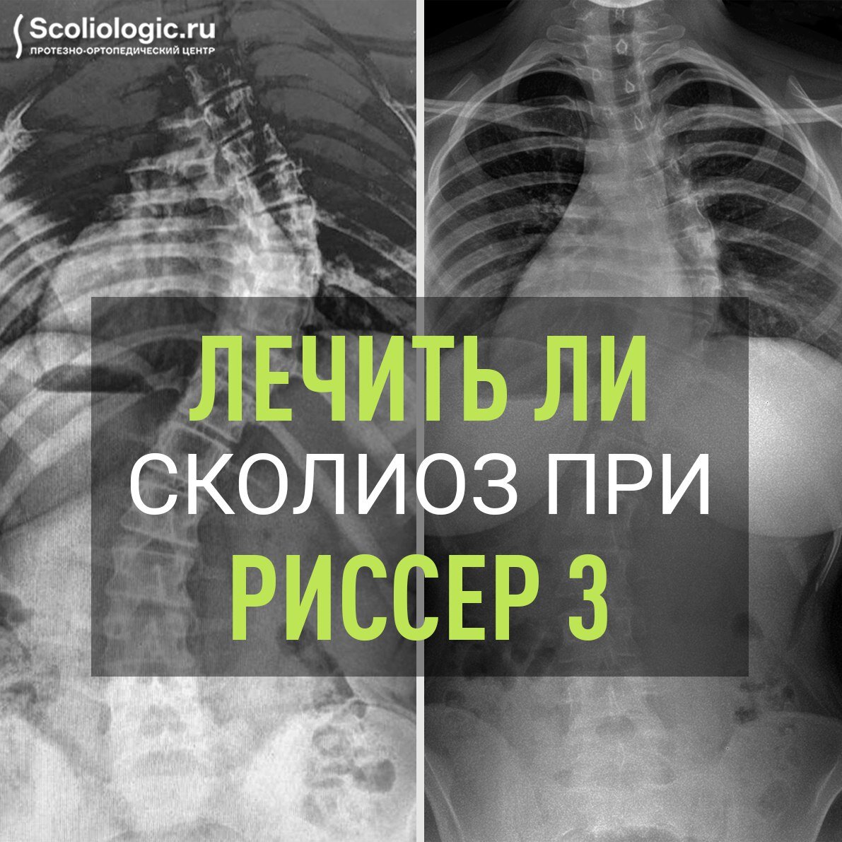 матрасы при сколиозе 2 степени