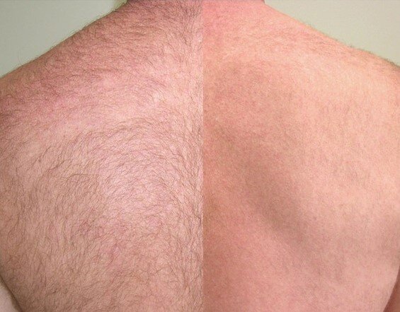 Цены на депиляцию спины воском (мужчины)