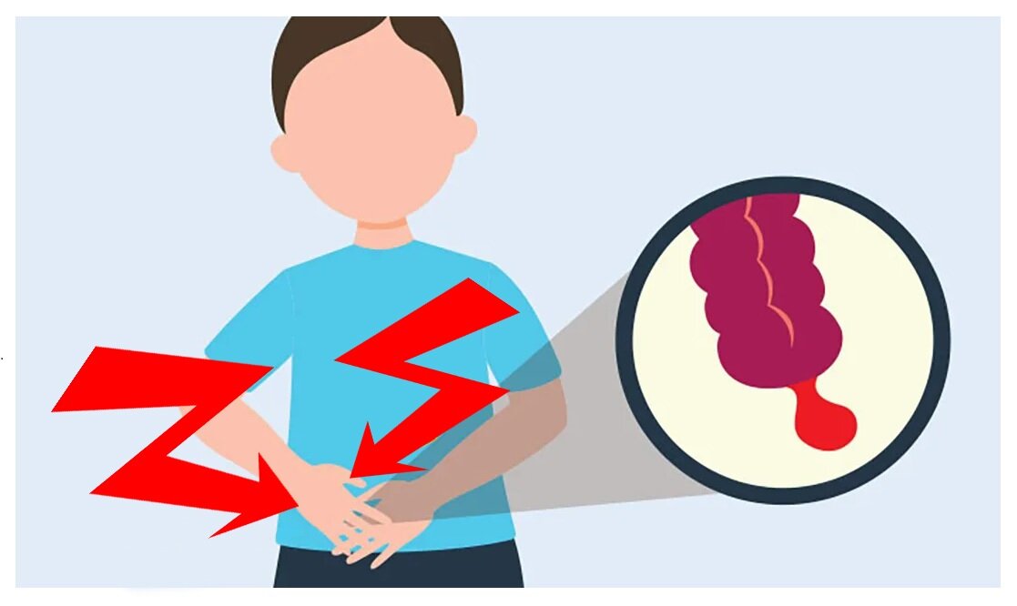 Острый аппендицит может привести к серьезным осложнениям