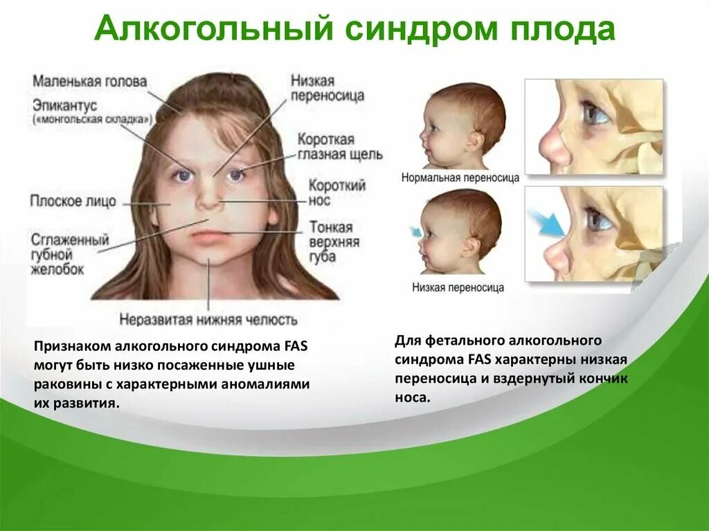 Некоторые изменения органа зрения у детей с фетальным алкогольным синдромом