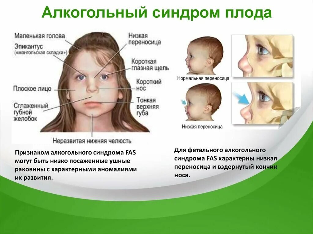 Что такое фетальный алкогольный синдром и чем он грозит