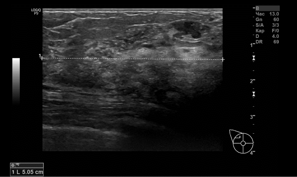 Мастопатия молочной железы узи