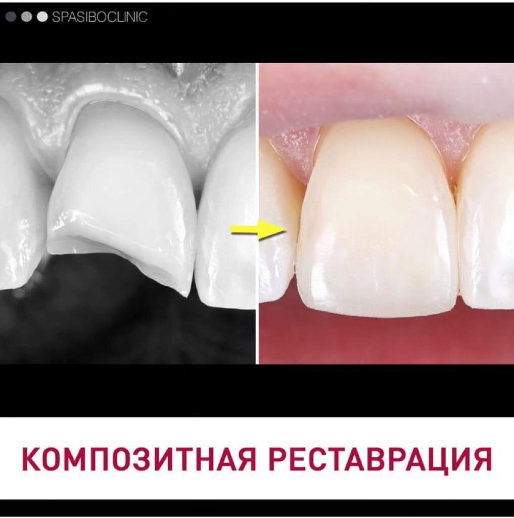Композитные реставрации зубов фото КОМПОЗИТНАЯ РЕСТАВРАЦИЯ Спасибо.Клиник Дзен