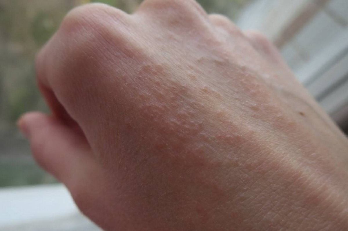    За 7 месяцев в Башкирии зарегистрировали 118 случаев чесотки