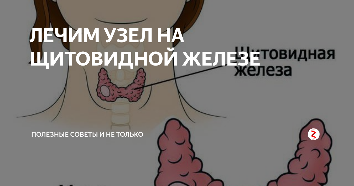 Как вылечить узлы. Узлы на щитовидной железе при нормальных гормонах. узел щитовидной железы мкб. узлы в щитовидной железе размеры норма. узлы щитовидной железы диагноз.