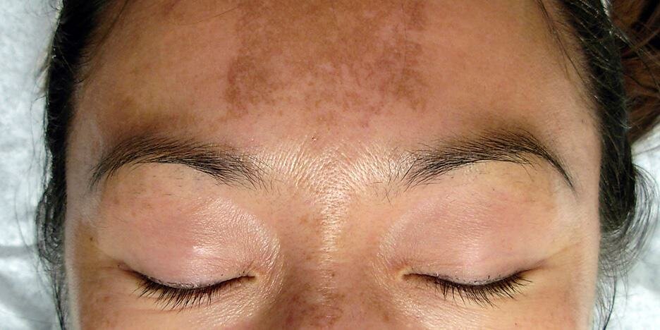 7 причин появления пигментных пятен на лице. Рецепт отбеливания | looklife  | Дзен