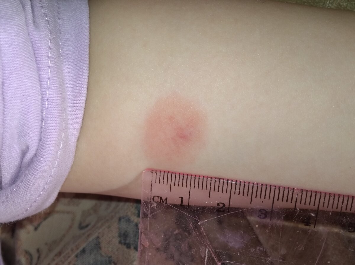 "Манту" вечером после прививки