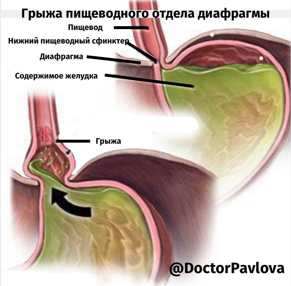 Где находится пищеводное отверстие диафрагмы фото