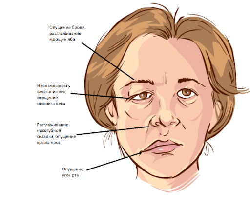 Паралич Белла или иначе называемый идиопатическим периферическим параличом лицевого нерва чаще всего является причиной одностороннего поражения нервных волокон в тканях лица.-2