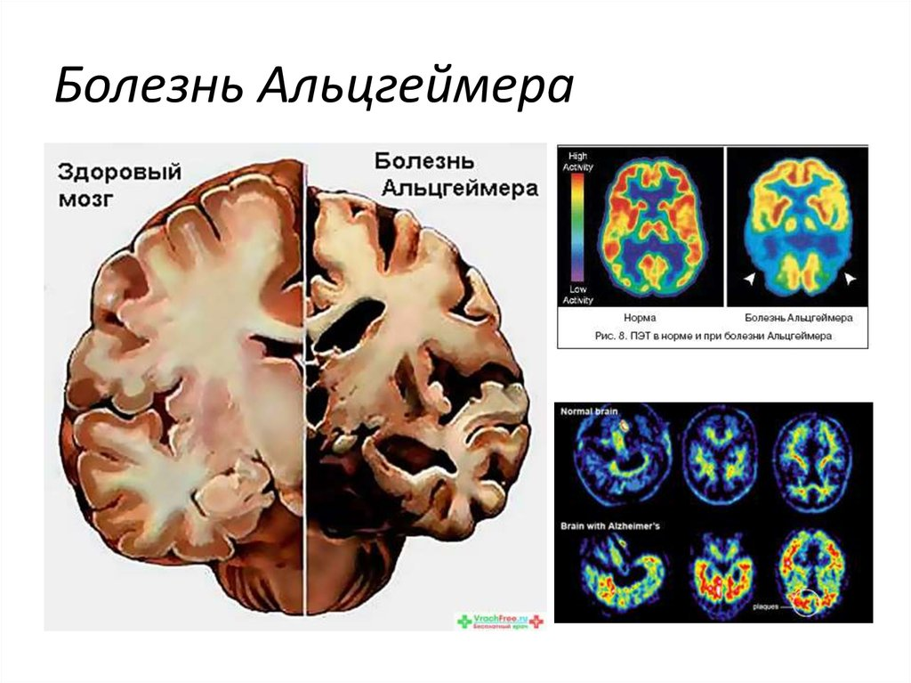 Органические изменения головного. Болезнь Альцгеймера. Синдром Альцгеймера. Поражение головного мозга. Болезнь Альцгеймера мозг.